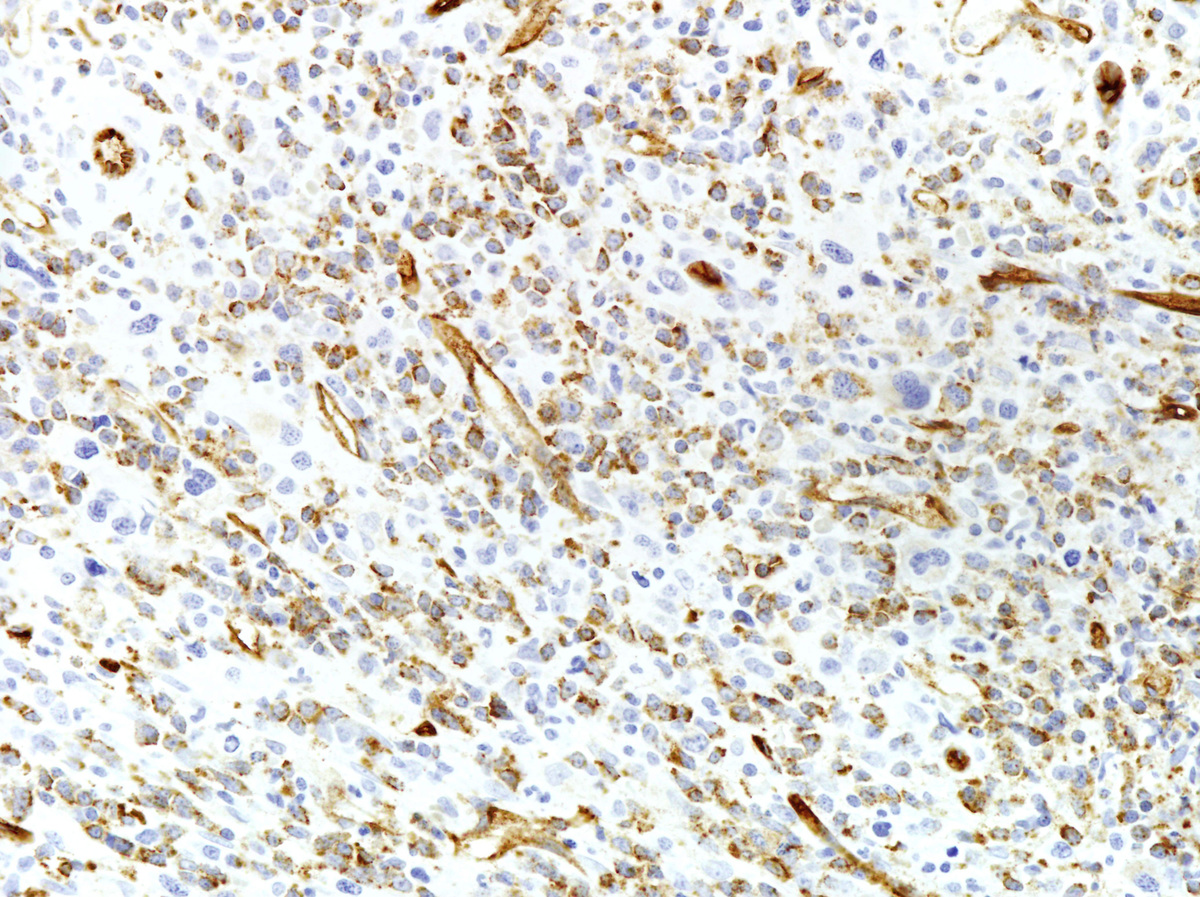 Submitted marrow (1999): The blasts were diffusely positive for CD34.  